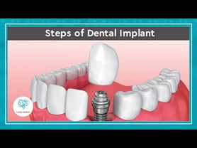 Dental implant demonstration