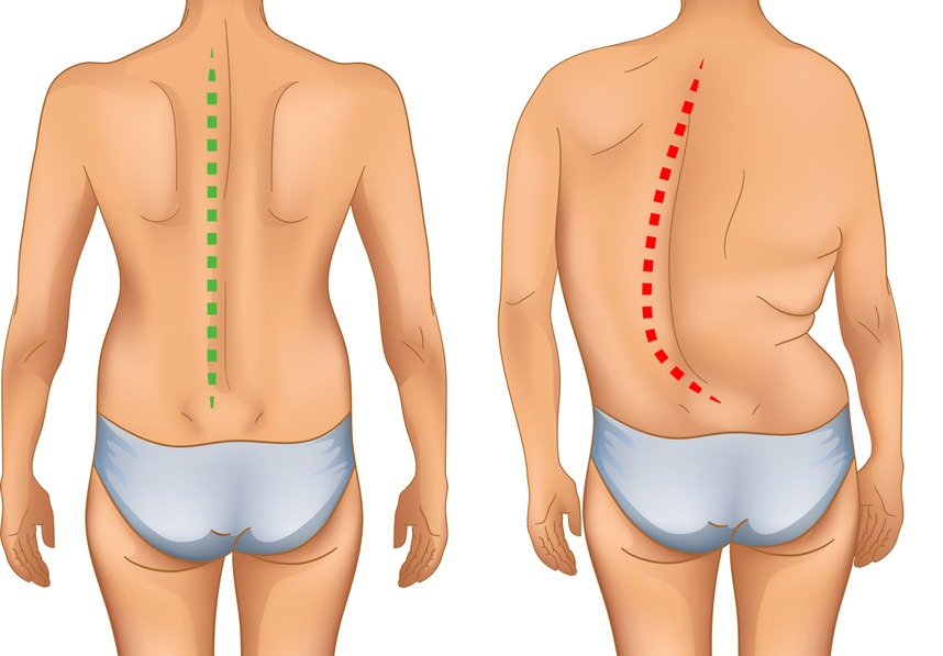 Стул при искривлении позвоночника