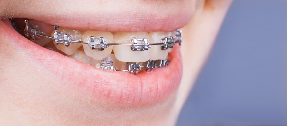 Как сделать самодельные брекеты What To Know About Metal Braces?, metal braces