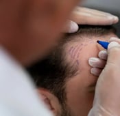 Hair Transplant in Turkey